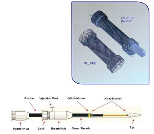 PALLIATOR  - ESOPHAGEAL STENT